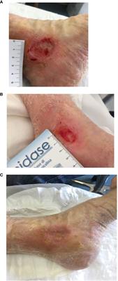 Case report: The use of PRP in the treatment of diabetic foot: case series and a review of the literature